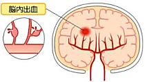 脳内出血