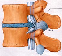 椎間板ヘルニア