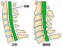 頚椎症