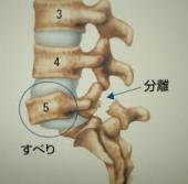 分離症