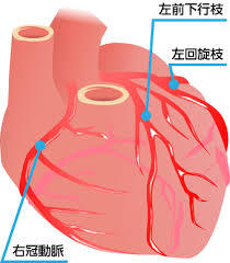 心筋梗塞　血管３本