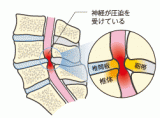脊柱管狭窄症